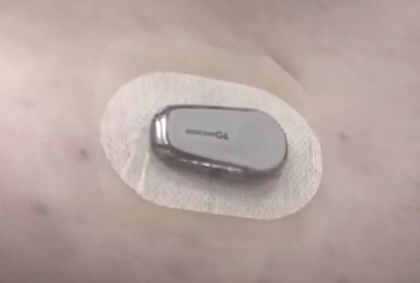 Hydrocolloid Bandages for Dexcom Irritation